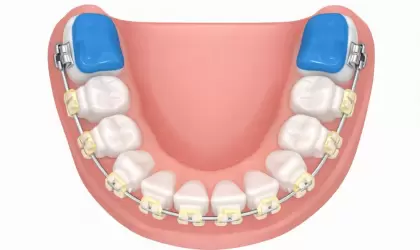 Ортодонтические накладки на зубы: зачем они нужны при ношении брекетов?