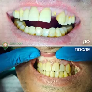 Установка временной, заранее изготовленной коронки на имплантат в момент его установки. Врач: Богданец Ю.А.