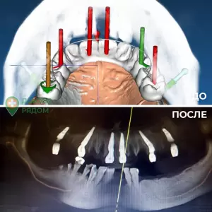 Компьютерное планирование и создание хирургического шаблона для проведения операции дентальной имплантации в соответствии с формой и положением будущих зубов. Врач: Богданец А. Ю.