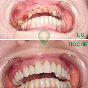 Пример работы по протезированию тотал - доктор Богданец А. Ю.