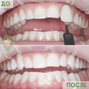 Пример работы по отбеливанию зубов