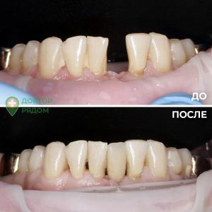 Пример быстрого шинирования и восстановления утраченного зуба в одно посещение за 2 часа