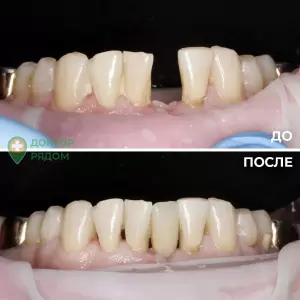 Пример быстрого шинирования и восстановления утраченного зуба в одно посещение за 2 часа