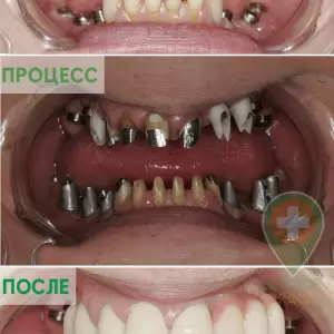 Протезирование