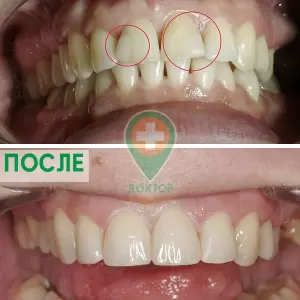 Установка виниров (безметалловых конструкций) в стоматологии Доктор Рядом