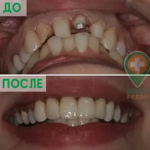 Установка виниров (безметалловых конструкций) в стоматологии Доктор Рядом