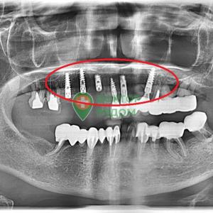 Установка шести имплантов верхнего зубного ряда возрастному пациенту