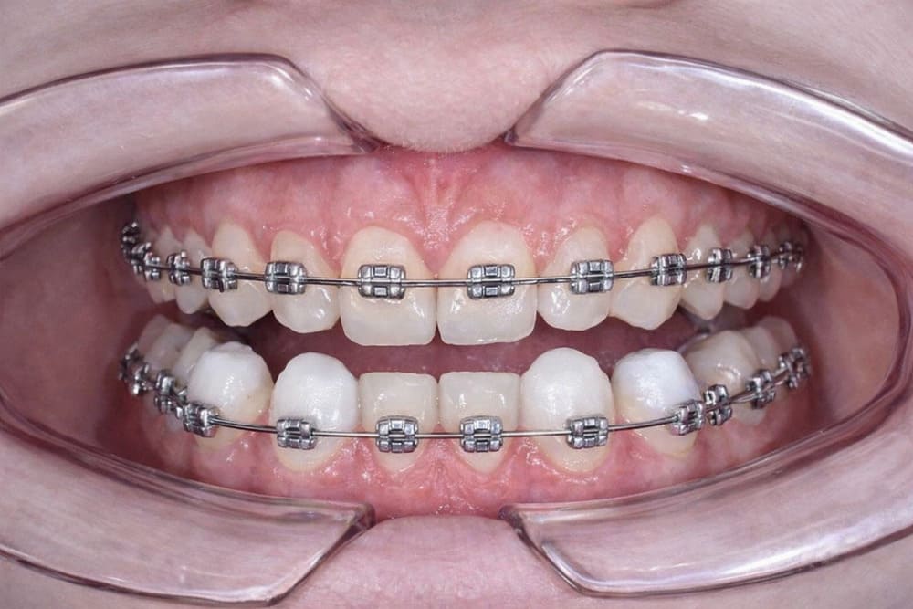 Зубы с установленными брекетами