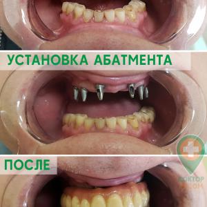 Имплантация зубов - доктор Лапковский В. И. 