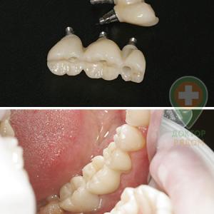 Имплантация зубов - доктор Зенкевич Ю. В. 
